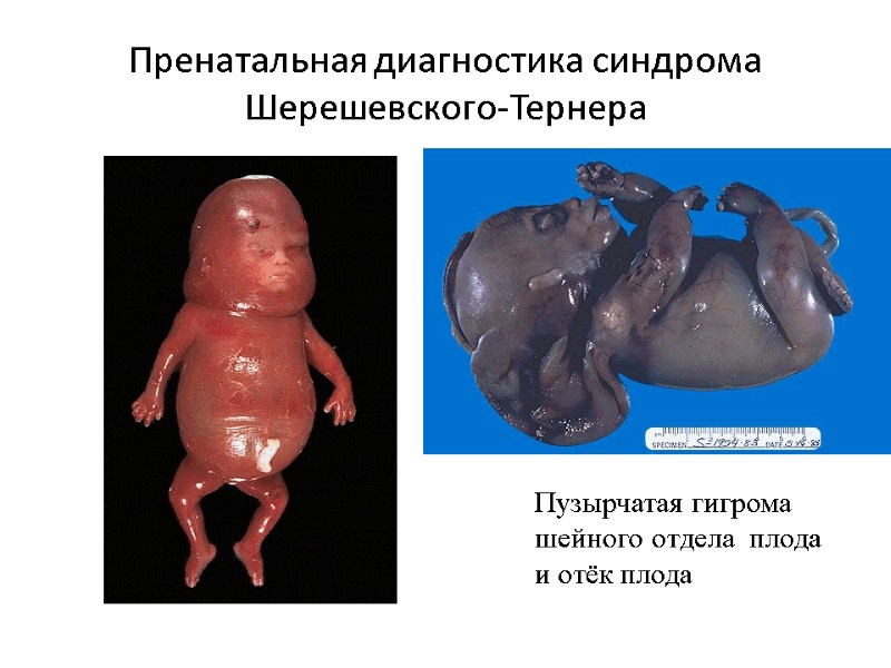 Пренатальная диагностика синдрома Шерешевского-Тернера Пузырчатая гигрома  шейного отдела  плода и отёк плода